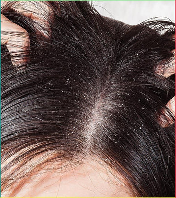 Dry Scalp Causes: 5 Causes You Should Know
