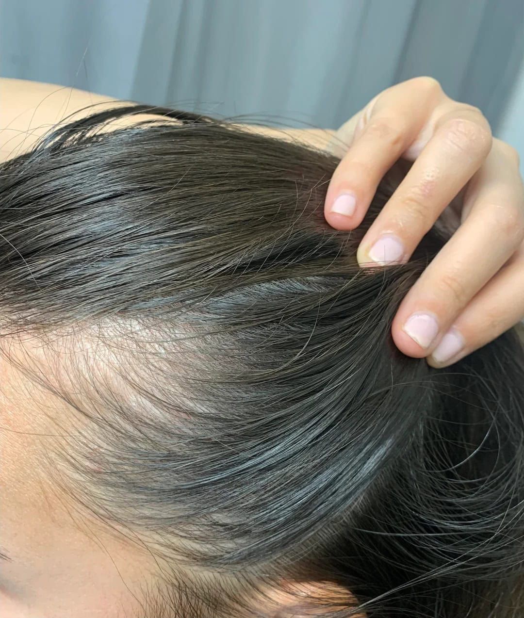 Dandruff and Hair Loss: Causes, Myths, and Fixes