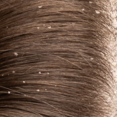 Dry Scalp Causes: 5 Causes You Should Know