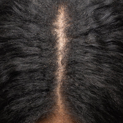 Should I Wash My Hair Every Day If I Have Dandruff?