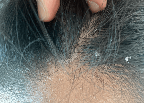 Seborrheic Dermatitis: Causes, Symptoms & Treatment